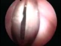 Stroboscopy: Flexible Fiberoptic: Normal Vocal cords up close