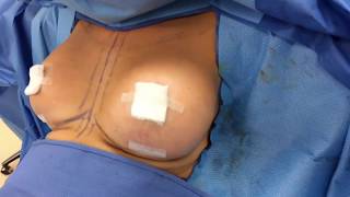 Breast Augmentation with Implants - Before and After - Dr. Anthony Youn