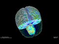 T1 brain with tumor perfusion volume