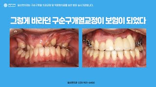 일산연치과, 그렇게 바라던 구순구개 애들 교정이 보험이 되었다