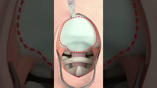 Craniectomy surgical procedure 3D animation. #asmr #lulu_asmr #animation