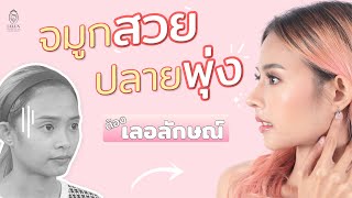 [รีวิวศัลยกรรมจมูก OPEN 1เดือน]จมูกสวย ปลายพุ่ง ต้องเลอลักษณ์