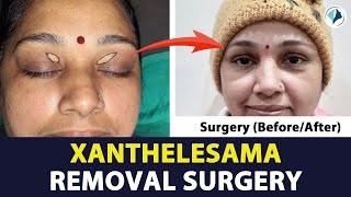 Xanthelasma Removal Before After | जैंथिलास्मा / Xanthelasma Laser Removal Before and After