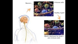 Advancing MS Are You Sabotaging Your Treatment