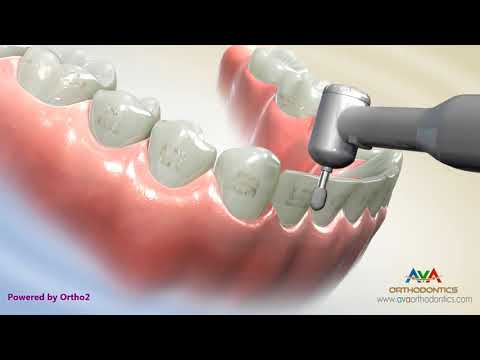 Taking Braces Off - Orthodontic Treatment Taking Braces Off - Orthodontic Treatment