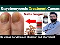 Nail fungus treatment at home|nail fungus homeopathic treatment|onychomycosis treatment