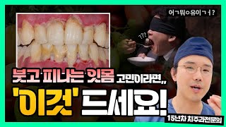 아직도 인사돌 이가탄 드세요? 붓고 피나는 잇몸에 좋은 음식 알려드립니다