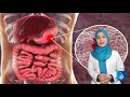 د معدې زخم ulcer