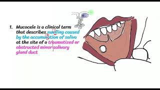 Mucocele HISTOPATHOLOGY,Mucous Extravasation cyst vs Mucous retention cyst | Etiopath,Clinical