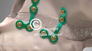 Corrective Jaw Surgery Orthognathic Animation
