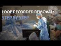 Getting your loop recorder removed? Watch a live procedure!