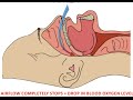 Obstructive Sleep Apnea