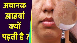 अचानक झाइयां क्यों पड़ती है, Pigmentation से बचाव का जबरदस्त तरीका | Boldsky