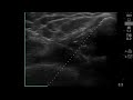 How to do an ultrasound guided medial knee injection