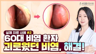 60대 비염 환자, 10년 동안 고생한 실제 치료 사례 후기 👃 (기침, 목 찢어짐, 콧물)