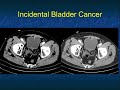 Missed Diagnosis in Abdominal CT: Strategies and Pitfalls - Part 2