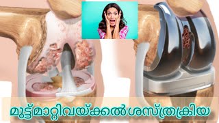 knee replacement surgery ||| മുട്ട് മാറ്റിവയ്ക്കൽ ശസ്ത്രക്രിയ