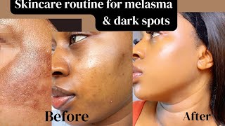 How I cleared my Melasma & Hyperpigmentation