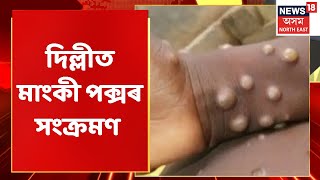 Monkey Pox | এইবাৰ দেশত  Monkey Poxৰ আতংক | Assam News | National