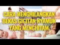 🔥 Cara Cepat Menghilangkan Bekas Gigitan Nyamuk Yang Menghitam pada Bayi