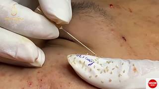 Removing blackheads by hand is as easy as eating a candy (174) | Loan Nguyen