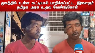 முகத்தில் உள்ள கட்டியால் பாதிக்கப்பட்ட இளைஞர் - தமிழக அரசு உதவ வேண்டுகோள்