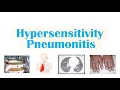 Hypersensitivity Pneumonitis | Hot Tub Lung, Farmer’s Lung, Bird Fancier’s Lung, Bagassosis