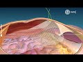 how laparoscopic mesh repair works for hernia a step by step explanation