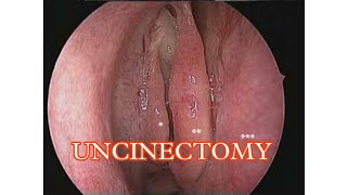 EASY WAY TO OPEN MAXILLARY SINUS / UNCINECTOMY