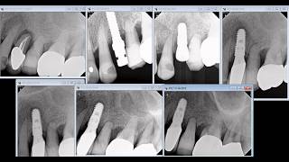 Retrograde peri implantitis - Wheaton dentist