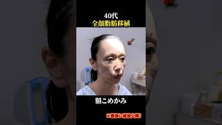 【40代全顔脂肪注入】ご本人の感想は？#脂肪注入 #頬コケ #脂肪注入ダウンタイム#脂肪移植 #額こめかみ脂肪注入#ほうれい線 #目の下ゴルゴ#short