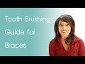 Braces Cleaning Routine | Tooth Brushing Guide for Braces