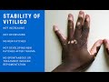 Stability of Vitiligo | Latest Developments [2020]