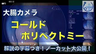 ポリープの治療②　【コールドポリペクトミー】