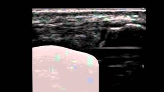 Musculoskeletal Ultrasound: Hand 14: lateral longitudinal scan of MCP joint