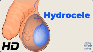 Dealing with Hydrocele: Understanding the Condition and How to Manage It