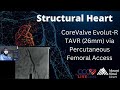 CoreValve Evolut-R TAVR (26mm) via Percutaneous Femoral Access Structural Heart - April 2016 Webcast