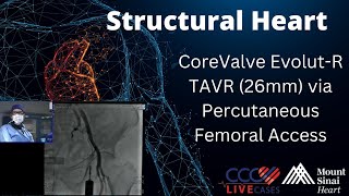 CoreValve Evolut-R TAVR (26mm) via Percutaneous Femoral Access Structural Heart - April 2016 Webcast