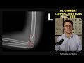 elbow joint anatomy radiology anatomy part 1 prep elbow bones alignment and fat pads on x ray