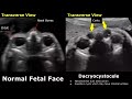 Fetal Face Ultrasound Normal Vs Abnormal Image Appearances | Eye Abnormalities | Obstetric USG