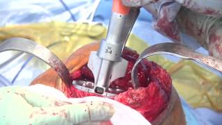 Total Knee Arthroplasty - Dr. Brayton Shirley