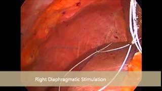 Diaphragmatic Pacer in an ALS Patient