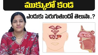 #AskDrHarika || Nasal Polyps Causes, Symptoms \u0026 Treatment Options || Dr Harika ENT Care Hospital