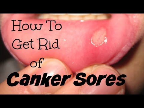 How To Get Rid of Canker Sores How To Get Rid of Canker Sores
