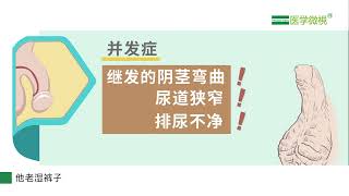 尿道下裂术后可能有哪些并发症？