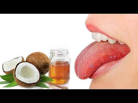 Top 5 Home Remedies To Cure Blisters On Tongue Top 5 Home Remedies To Cure Blisters On Tongue