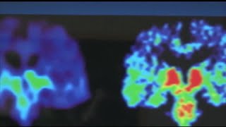 Uva Doctors Explosive Blasts May Harm Brain Health
