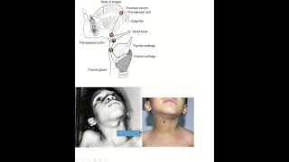 Thyroglossal cyst vs branchial cyst