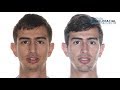 Bimaxillary orthognathic surgery. Case #60: Andrés- Class 2, overbite, bi-retrusion, short face