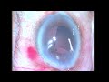 Techniques Of IOL Explantation in Phacoemulsification Surgery